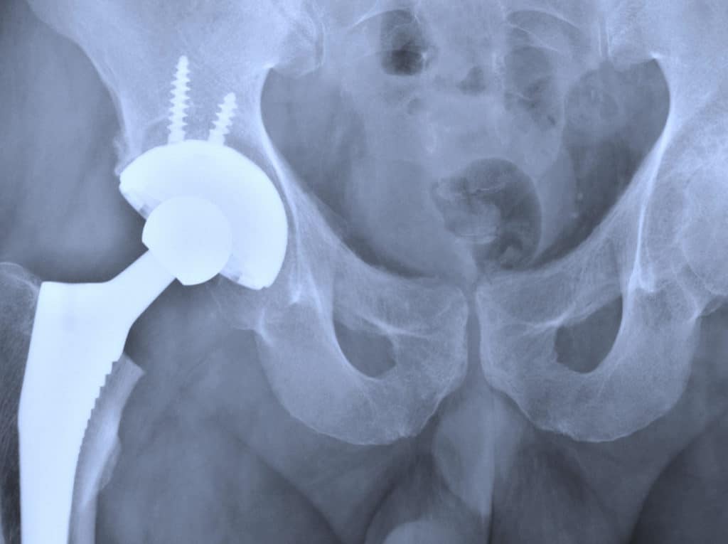 Johnson & Johnson To Pay $4B In Hip Implant Lawsuit