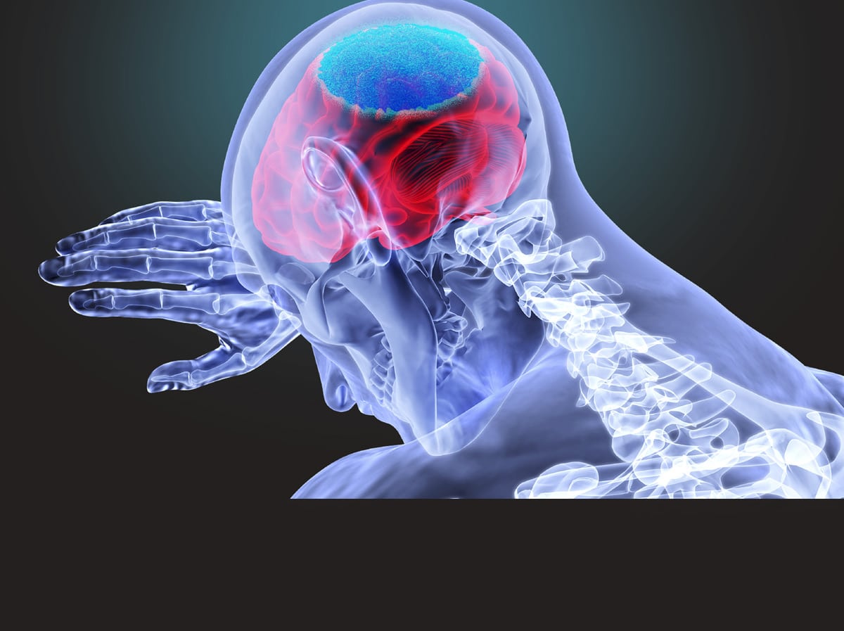 graphic of a concussion injury